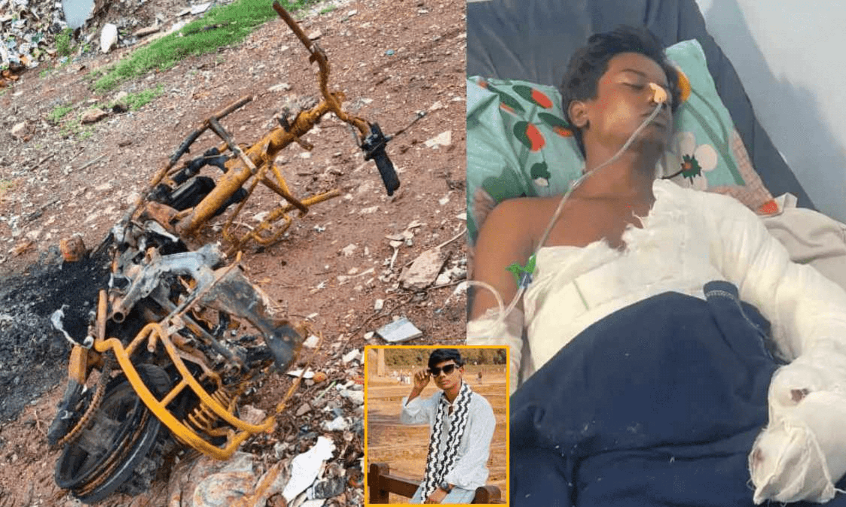शराब पार्टी के बहाने ले जाकर युवक को पेट्रोल से जिंदा जलाया, 7 दिन चले इलाज के बाद मौत; परिजनों ने लगाया पुलिस पर लापरवाही का आरोप